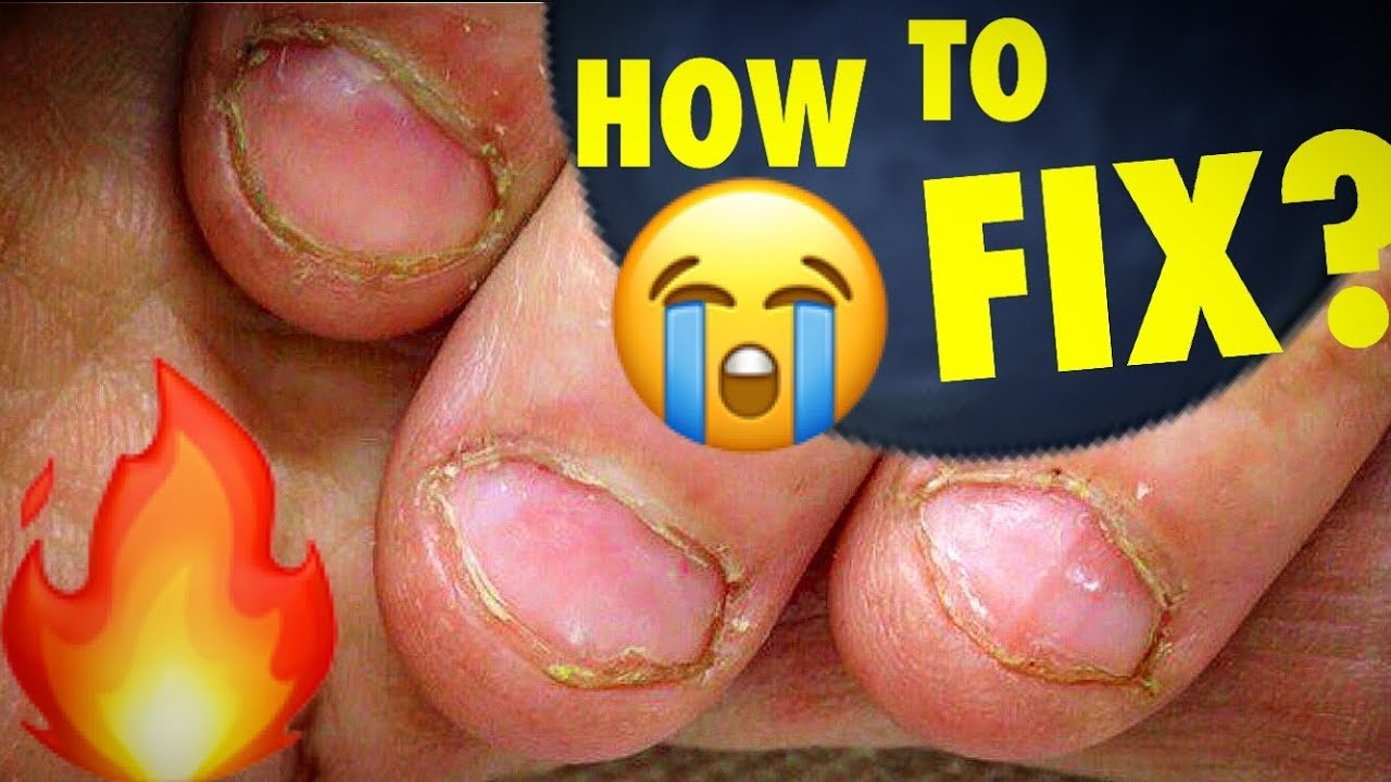 Amazing Transformation of Extremely Bitten Nails How to Fix Short Bitten Nails