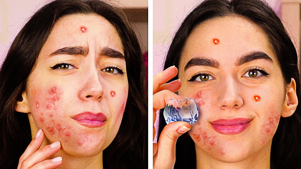 22 GENIUS BEAUTY HACKS || ACNE TREATMENTS