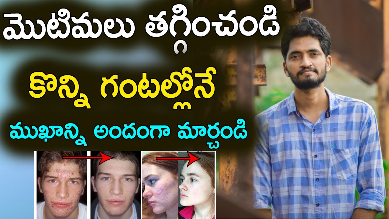 How To Remove Pimples Overnight | Men’s Face Beauty Tips In Telugu | Naveen Mullangi