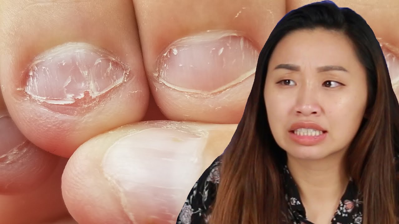 Nail Biters Learn Horrifying Facts About Biting Your Nails