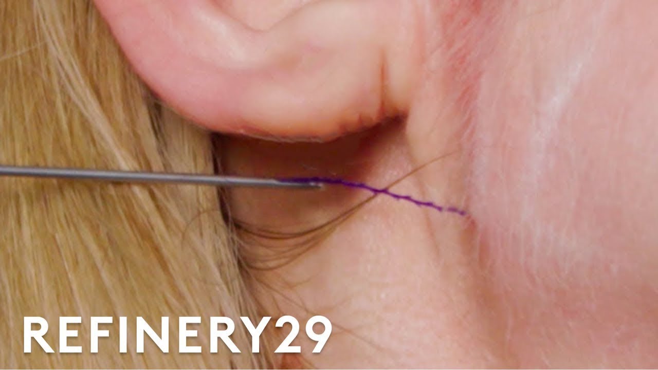 I Got A Thread Injection Facelift | Macro Beauty | Refinery29