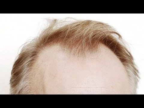 Top 10 Hairstyles for Balding Men Ideas