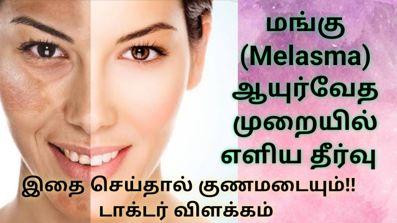 மங்கு மறைய | Mangu maraya tips in tamil | Melasma Home remedies | Tamil beauty tips